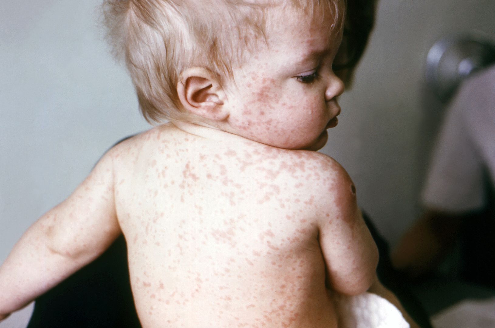  photo 10-measles-full_zpsf819fc1b.jpg